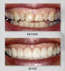 Full Mouth Restoration