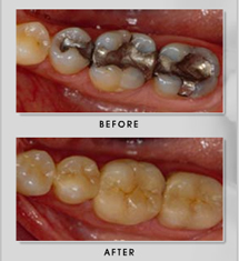 Non-Metal Fillings