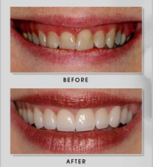 Smile Design