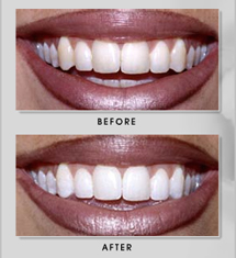 Teeth Whitening